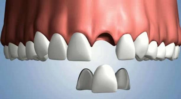 dental bridge