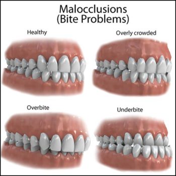 Underbite vs. Overbite: What's the Difference and How are They