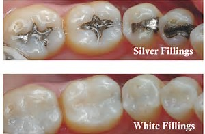 Advanced Dental Tooth Color Fillings Treatment, Dentist, Clinics Los  Angeles, CA