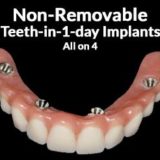 dental implants los angeles, all on 4 dental implants los angeles, all on 4 dental implants, dentist los angeles, restorative dentistry