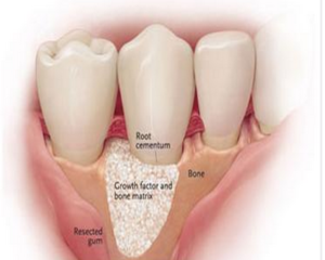 dental implant, los angeles, dental implants los angeles, bone grafting, bone grafting los angeles, restorative dentistry, cosmetic dentistry