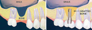 dental implant los angeles, sinus lift, sinus lift los angeles, dental implants, cosmetic dentistry, restorative dentistry
