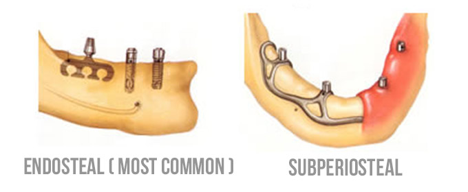 Endosteal dental Implants vs subperiosteal dental implants
