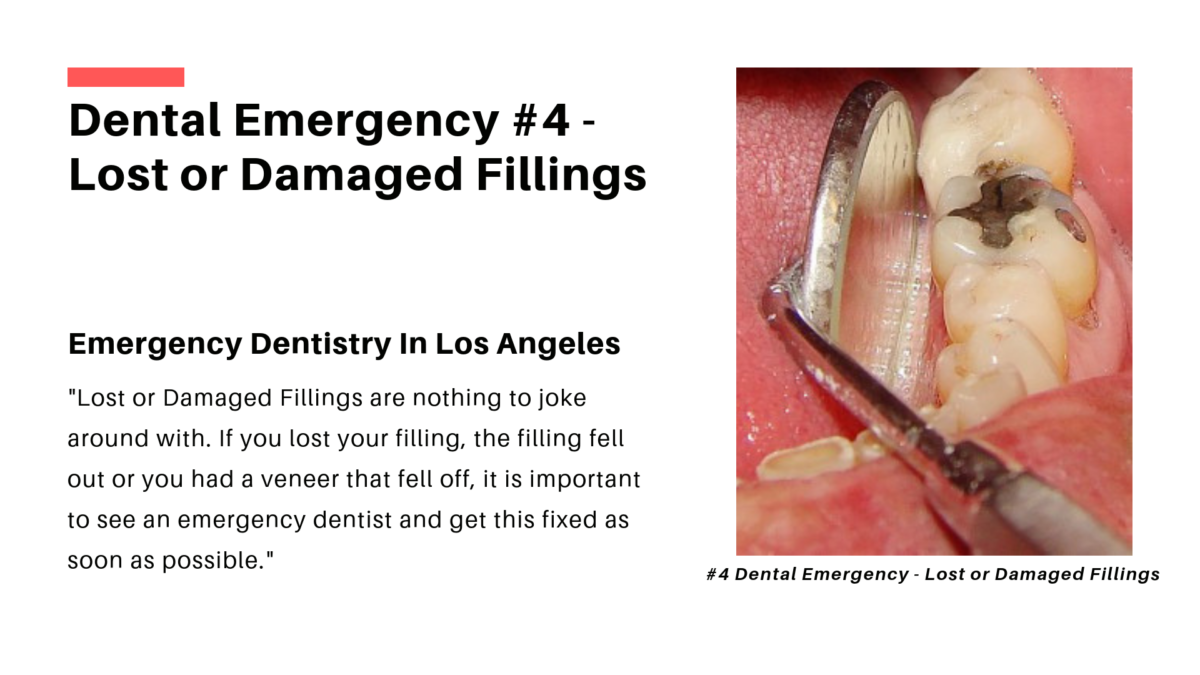 Silver Filling Emergency Dentistry