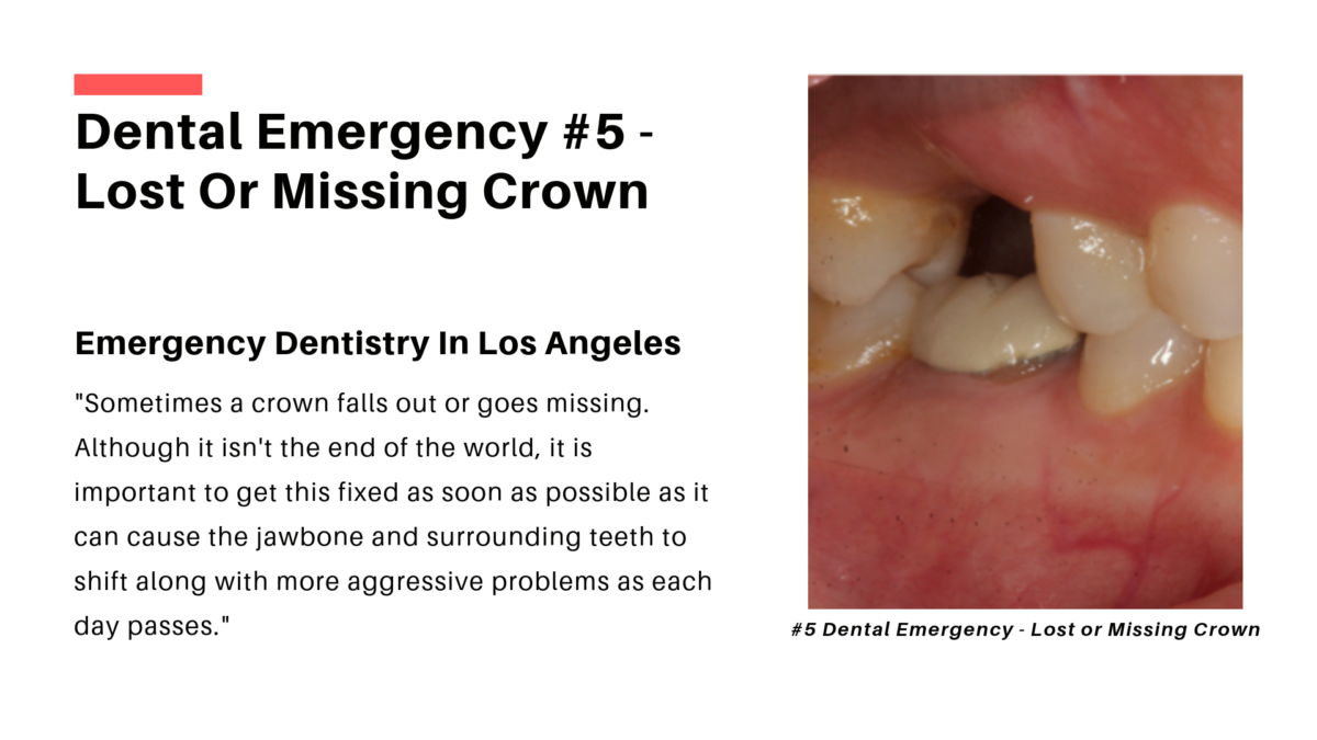 Missing Crown Los Angeles Emergency Dentistry