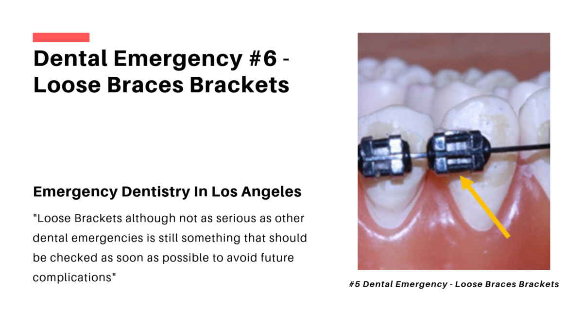 Emergency Dentistry Los Angeles Loose Braces Brackets