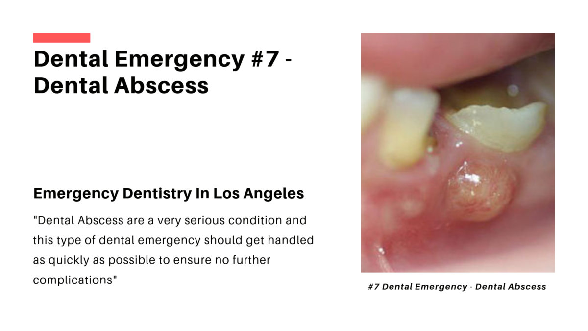 Emergency Dentistry Dental Abscess