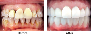 Full Mouth Reconstruction Los Angeles