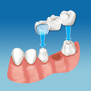 Dental Bridges by a Dental Surgeon & DDS