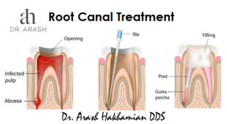 Root Canal Treatment Los Angeles