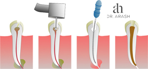 root canals in los angeles ca